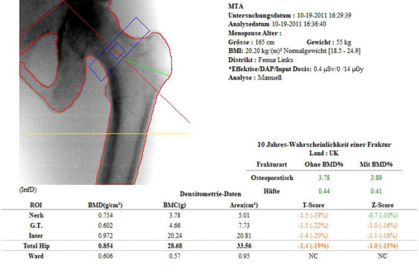 knochendichtemessung016382ADEF-7A06-822A-312C-8965713EA0C1.jpg